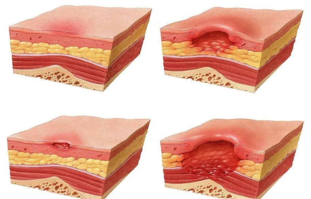 皇冠hga038_一觉醒来皇冠hga038，21岁女生的屁股惨不忍睹！严重或危及生命